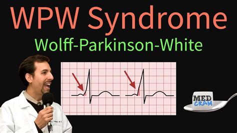 parkinson white syndrome ekg